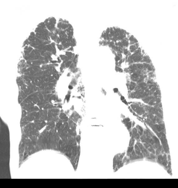 peribroncovascular 3.