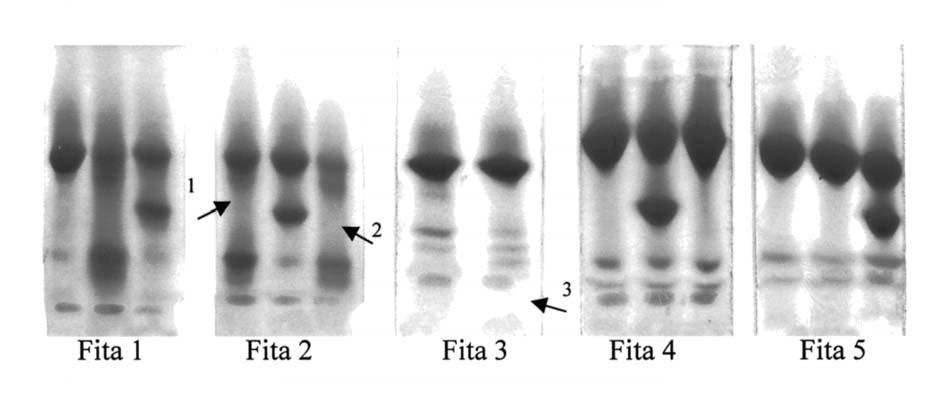 As Figuras 1 e 2 ilustram os procedimentos eletroforéticos em ph alcalino e ácido, onde se fundamenta o diagnóstico das principais hemoglobinopatias. Figura 1.