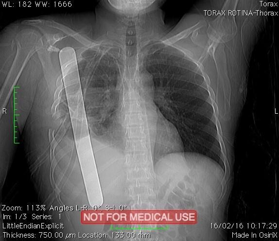 paciente permaneceu sob os cuidados da Cirurgia Geral, sendo acompanhado diariamente também pela Cirurgia Torácica.