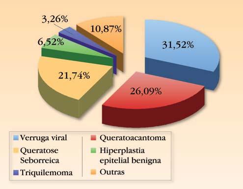 Corno cutâneo: estudo histopatológico retrospectivo de 222 casos 159 GRÁFICO 1: Distribuição das principais dermatoses benignas diagnosticadas histopatologicamente na base do corno cutaneo 26,09%);