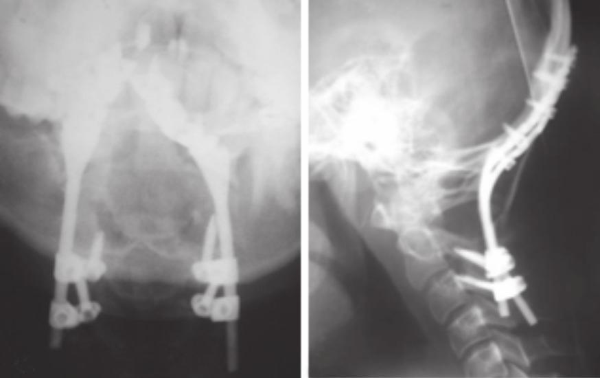 na incidência ântero-posterior () e perfil () da artrodese occipito-c3 Figura 6 Radiografias nas incidências ântero-posterior () e perfil () com dois anos de seguimento pós-operatório so do osso