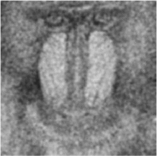 2.13) Imagem resultante de 5 iterações de sigmaedge com janela 5x5 Tabela (4.2.3) RSR dos resultados obtidos Figura Relação Sinal Ruído (db) 4.