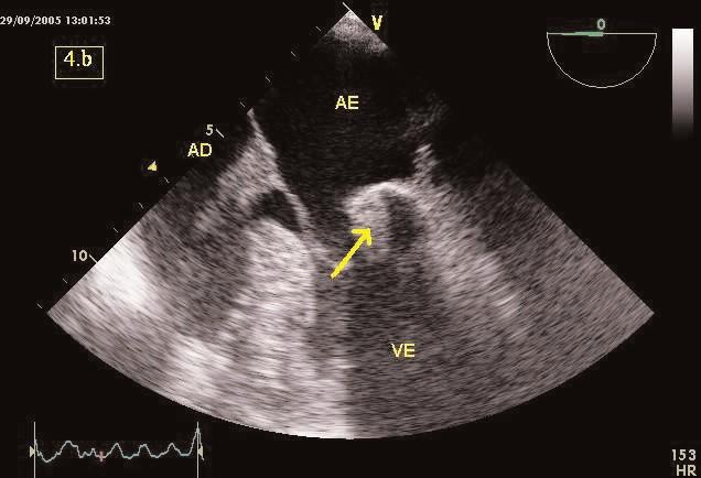 TA: 150/95 mmhg, frequência cardíaca (FC) de 62 bpm, auscultação, cardíaca e pulmonar, sem alterações, sem edemas, organomegálias ou ingurgitamento jugular.