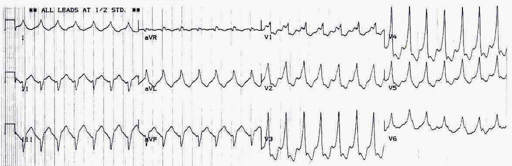 Taquicardia com QRS