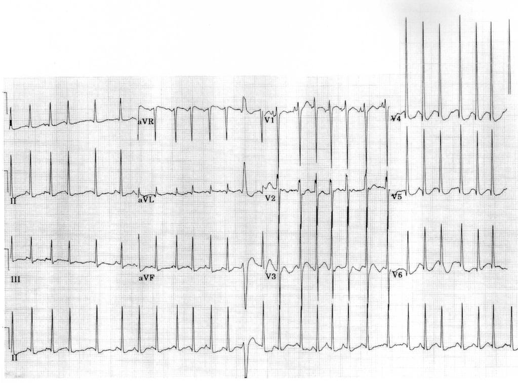 Taquicardia atrial