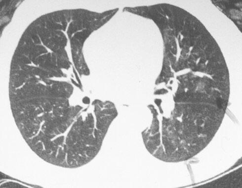 Pneumonia por Vírus Sincicial Respiratório Vírus Total Trato Superior Trato Inferior VSR 47 24(51%) 23(49%) Parainfluenza 72 56(78%)