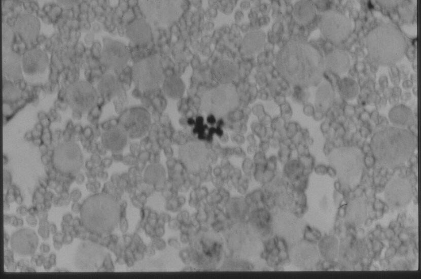 DIAGNÓSTICO DIFERENCIAL DE LESÕES INTERSTICIAIS DE ORIGEM INFECCIOSA Pneumocystis jirovecii Pneumocistose Diagnóstico Diferença (A-a)O 2 M = 41mmHg (Kovacs) LDH em 90% (< especificidade) Escarro