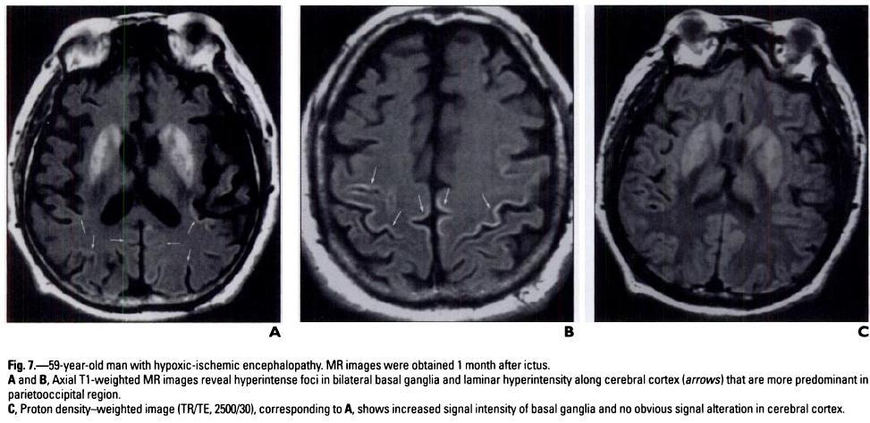 ENCEFALOPATIA HIPÓXICO-ISQUÊMICA - morte ou profundo déficit neurológico: crianças e adultos.