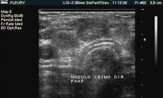 Diagnóstico do bócio nodular BMN - Investigar nódulo com