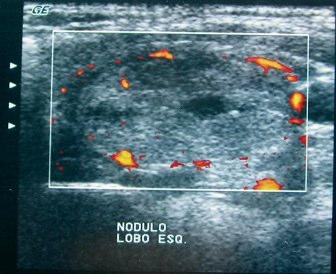 Diagnóstico do bócio nodular - US Doppler Fluxo periférico