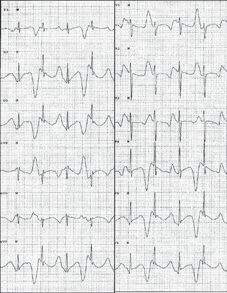 desde os 9 meses e surdez congênita (Jervell-Lange-Nielsen). Intervalo QTc: 670ms, com evidência de alternância de onda T. possível documentar arritmia ventricular polimórfica em nenhum paciente.