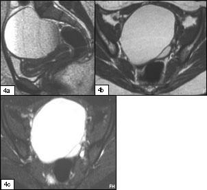 O diagnóstico diferencial é feito com teratoma, quisto funcional hemorrágico, fibroma, abcesso tubo-ovárico e cistadenocarcinoma.