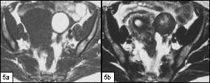 atenuação posterior (devido à presença de gordura e cabelos no seu interior ou de calcificações no interior do nódulo de Rokitansky).