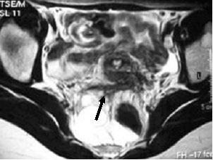 10) e a justaposição de endometrioma ou estrutura digestiva pode mascarar um pequeno nódulo de endometriose profunda nos ligamentos útero-sagrados. Fig.