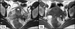 supressão de gordura e administração de contraste (7c), onde é realçado. Fig. 9 Mulher de 31 anos, com endometriose dos ligamentos úterosagrados.