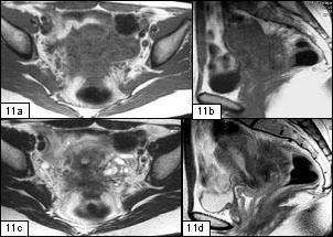 A apresentação da doença é idêntica à descrita para o envolvimento do torus uterino, com hipossinal em T2 e variedade de sinal em T1. Fig. 11 Mulher de 33 anos com endometriose no torus uterino.