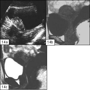 uterino ou espessamento assimétrico da porção inferior da sigmoideia.