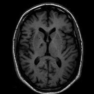 5T) Aquisição muito rápida Baia qualidade de imagem Muito usada para angiografia 3D Aquisição muito lenta