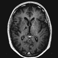 por densidade de núcleos Contraste T 1 Contraste T 2 T 1 DP T 2 T 1 +Gd Onde trabalhar com imagens médicas?