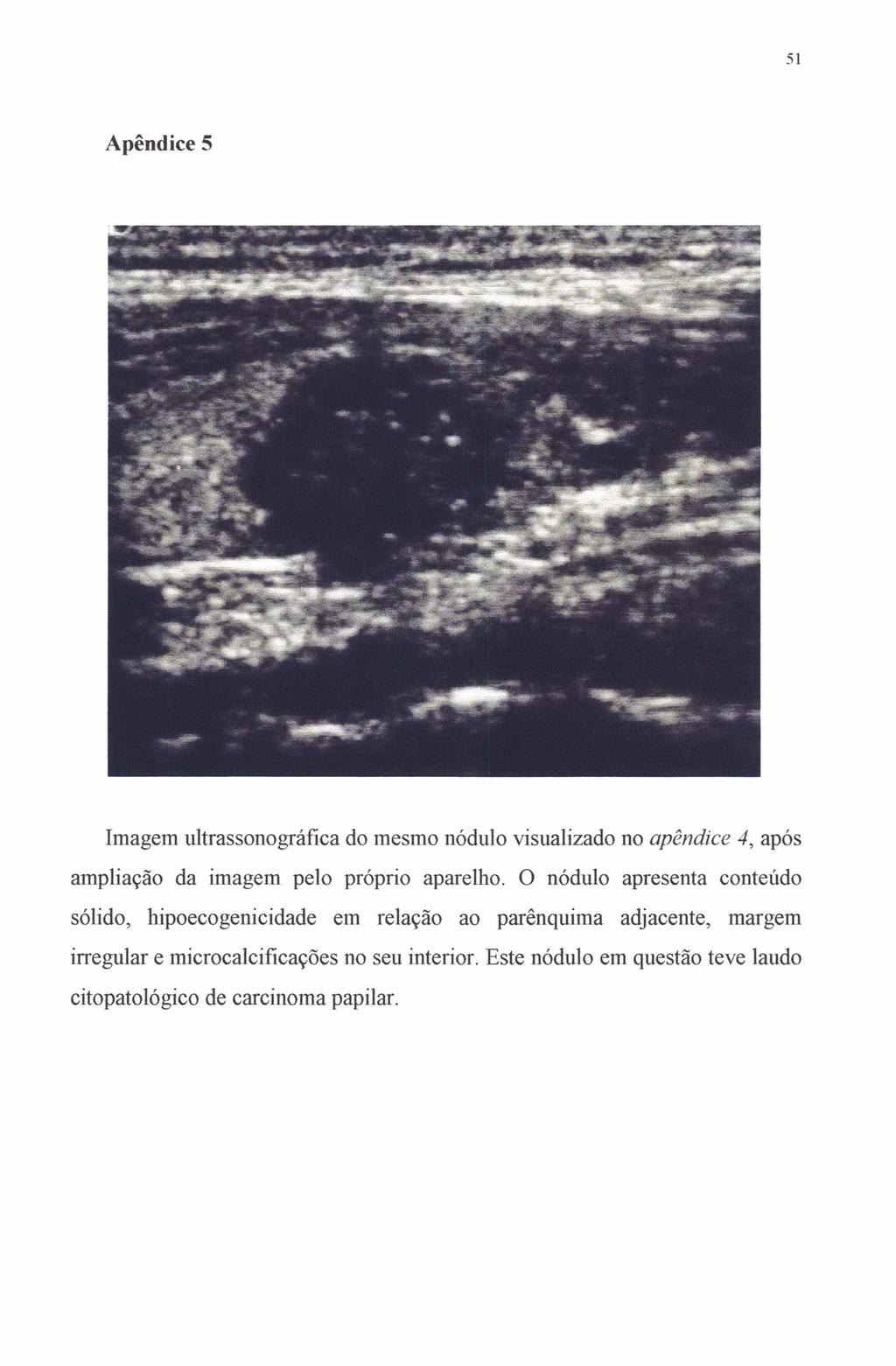 Sl Apêndice 5 Imagem ultrassonográfica do mesmo nódulo visualizado no apêndice 4, após ampliação da imagem pelo próprio aparelho.