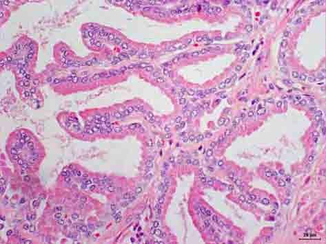 FIGURA 1 Próstata normal de cão. Nota-se epitélio secretor (seta preta), estroma de sustentação (seta vermelha) e lúmen glandular (asterisco). HE.