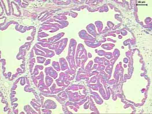 A hiperplasia epitelial (GIIA) se caracterizou por proliferação do epitélio acinar sob forma de projeções papilares para o interior do lúmen, cobertas por uma ou duas camadas de células epiteliais,