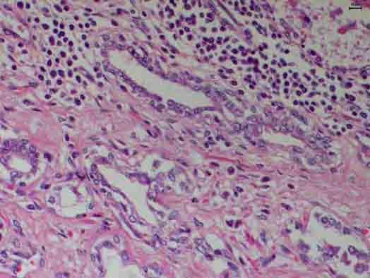 FIGURA 7 Atrofia inflamatória proliferativa (PIA). Células epiteliais atípicas com evidenciação nucleolar associadas a infiltrado inflamatório mononuclear. HE.