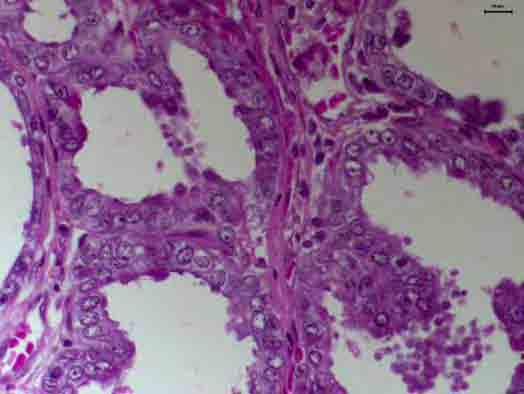 FIGURA 8 Neoplasia intra-epitelial prostática (PIN). Empilhamento celular, variação do tamanho nuclear e nucléolos evidentes. HE.