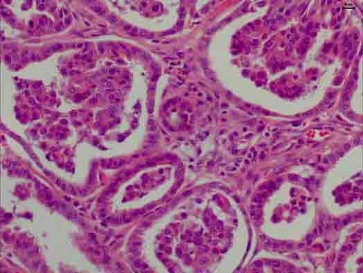 FIGURA 9 - Adenocarcinoma prostático. Ácinos compostos por células epiteliais atípicas com nucléolos evidentes e projeções papilíferas. HE. 4.2.