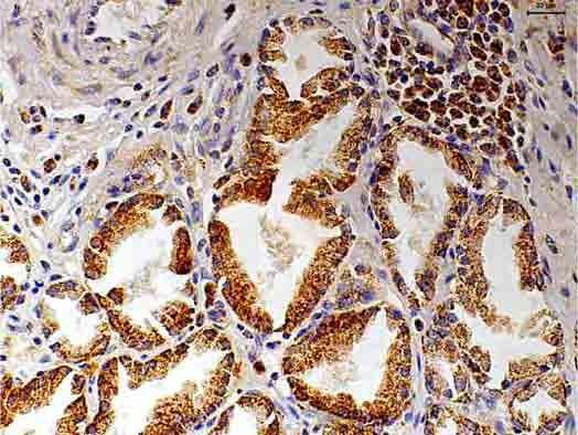 FIGURA 14 Neoplasia intra-epitelial prostática.