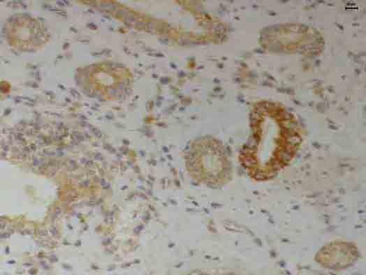 FIGURA 20 Atrofia inflamatória proliferativa.