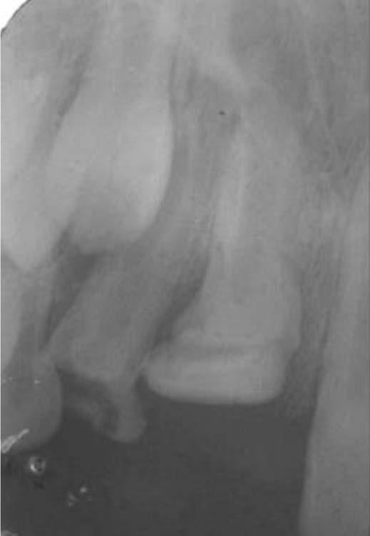 sua formação. O sequestro do germe do dente permanente caracteriza-se pela formação de um elemento dental subdesenvolvido e requer a remoção cirúrgica 13,20 (Figura 6). Figura 2.