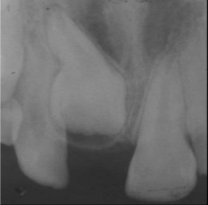 SEQUELAS EM DENTE PERMANENTE APÓS TRAUMA NO DECÍDUO Figura 4. Imagem radiográfica mostrando de dilaceração radicular do incisivo central superior direito permanente.