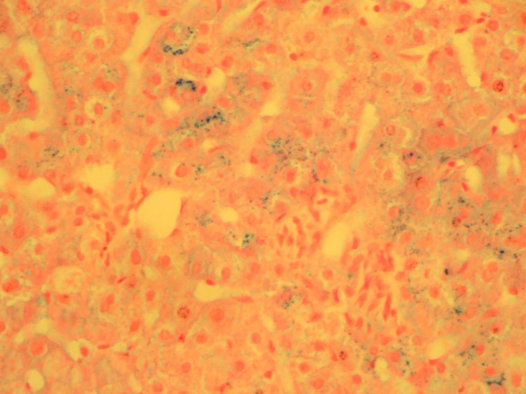 (A) Coloração de Hematoxilina-Eosina, evidenciando balonização hepatocelular moderada (200x).
