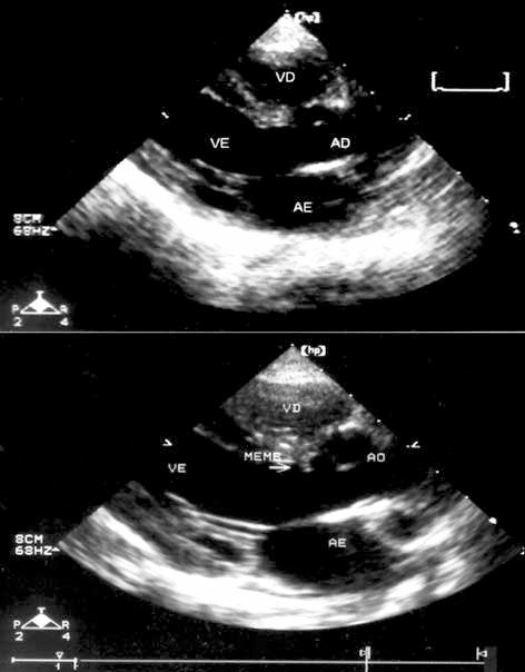 A estenose subaórtica pode surgir como complicação na evolução natural de várias cardiopatias congênitas, mas sua etiologia ainda é mal esclarecida 1,2.