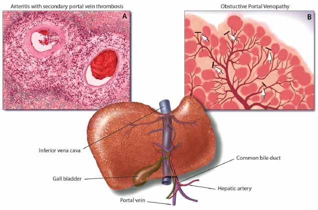 HNR Patogênese Arterite com trombose portal 2ª Venopatia obstrutiva portal