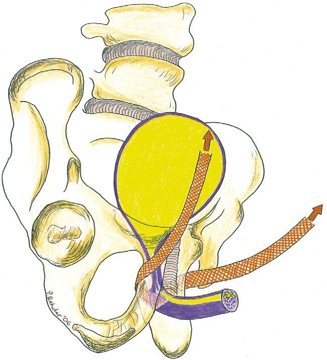 que se tornaram laxas e descaídas após cirurgia prostática. A via cirúrgica é por incisão perineal, a abordagem transobturadora e o implante do dispositivo feito sob a uretra bulbar.
