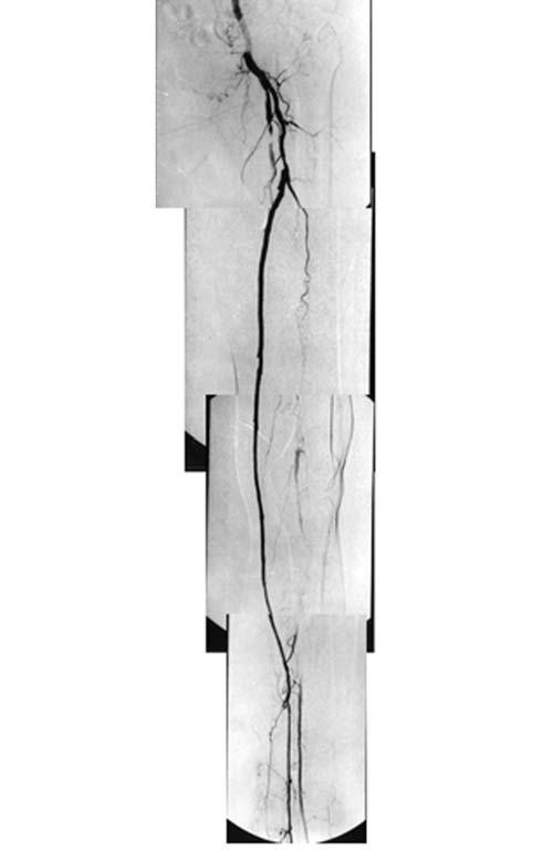 Artéria femoral profunda Brochado Neto FC et al. J Vasc Bras 2008, Vol.