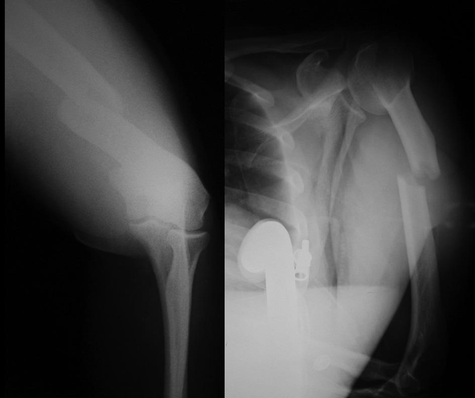 123 INTRODUÇÃO As fracturas diafisárias do úmero representam aproximadamente 1% de todas as fracturas. Resultam habitualmente de um traumatismo directo sob o membro superior 1,2,3.