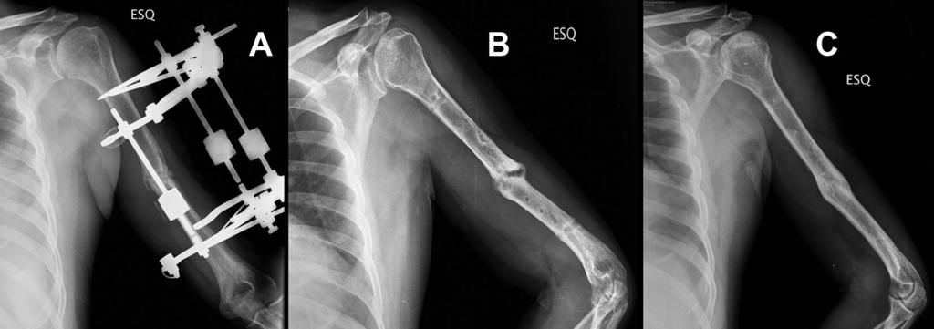 125 Figura 5. A) Rx de controlo após 5 meses e B) 1 ano: fractura em vias de consolidação. C) Rx após 2 anos, remodelação óssea.