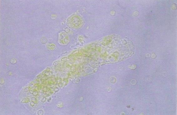 Cilindros hemáticos Podem conter células claramente identificáveis ou fortemente agrupadas, ligadas à