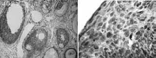 acentuada. NIC: neoplasia intraepitelial cervical. A Figura 8 Expressão da imunomarcação pelo Bax (A) NIC 3: reatividade acentuada, intensidade acentuada e positividade em toda a espessura epitelial.