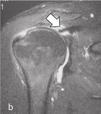 cavidade glenoidal (seta) e ascensão da cabeça do úmero; c- RNM axial T2, lesão do tendão subescapular (seta); d- RNM sagital T2, lesão do MR incluindo os tendões do supra-espinal e infra-espinal