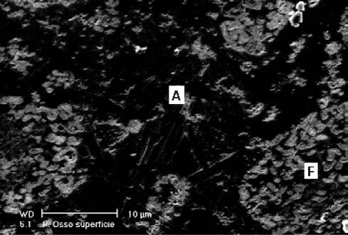S. R. Bragança et al. / Cerâmica 52 (200605-212 211 Figura 8: MEV da porcelana de ossos. Superfície da amostra queimada a 1240 ºC. A: anortita. F: tri-cálcio fosfato. Ataque ácido HF 10%, 10 s.