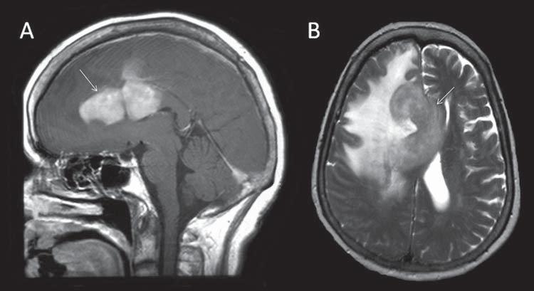 A espectroscopia com TE de 135 ms (B) demonstra aumento dos níveis de colina, redução dos níveis de NAA e pico invertido de lactato (dubleto em 1,3 ppm).