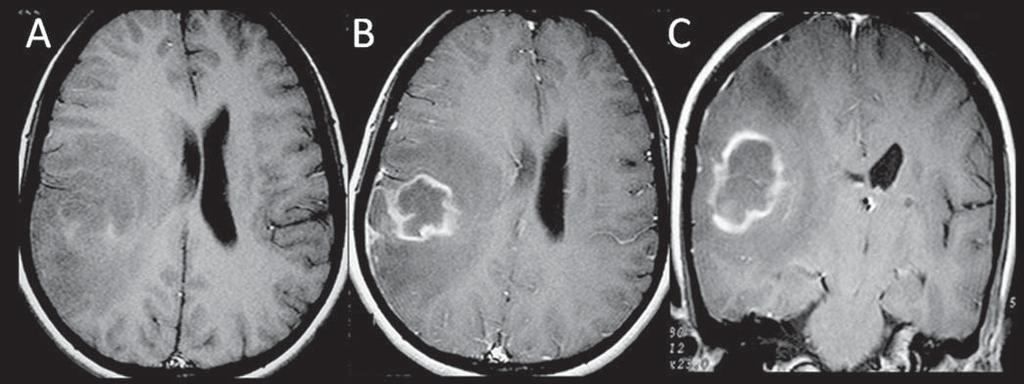 Figura 4. Paciente do sexo feminino, 32 anos, HIV positivo. RM axial T1 pré-contraste (A) evidencia lesão parietotemporal direita, com componentes de hipersinal (hemorrágicos).
