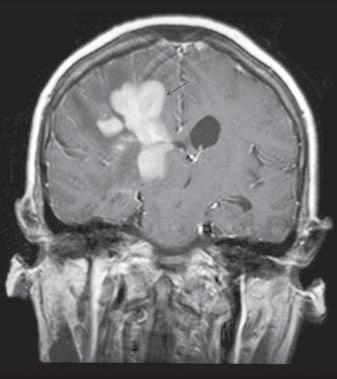 As lesões em pares cranianos também podem ser observadas, mas são relativamente infrequentes, podendo ser solitárias ou múltiplas (Figura 10) (3,4,8).