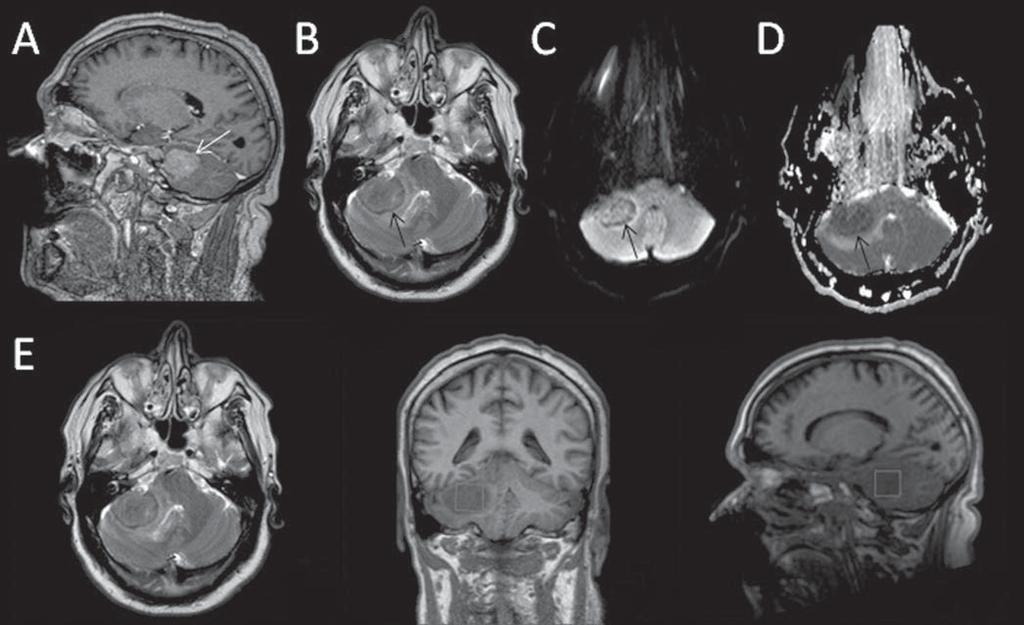 Figura 9. Paciente do sexo masculino, 59 anos. Imagem em T1 sagital fino após gadolínio (A) mostra massa com realce intenso pelo contraste no hemisfério cerebelar direito.