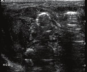 pneumatose intestinal Figura 2.