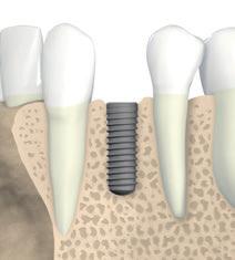 Implantes S/SP/TE b a D 1,5 mm 1,5 mm Diâmetro do ombro D (mm) Largura do espaço a min (mm) 3,5 (NNC) 5,5 6,5 4,8 (RN) 7 8 6,5 (WN) 8,5 9,5 Regra D + 2 mm D + 3 mm* Distância entre dentes adjacentes,